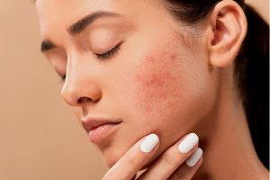 Read more about the article How to treat adult acne naturally